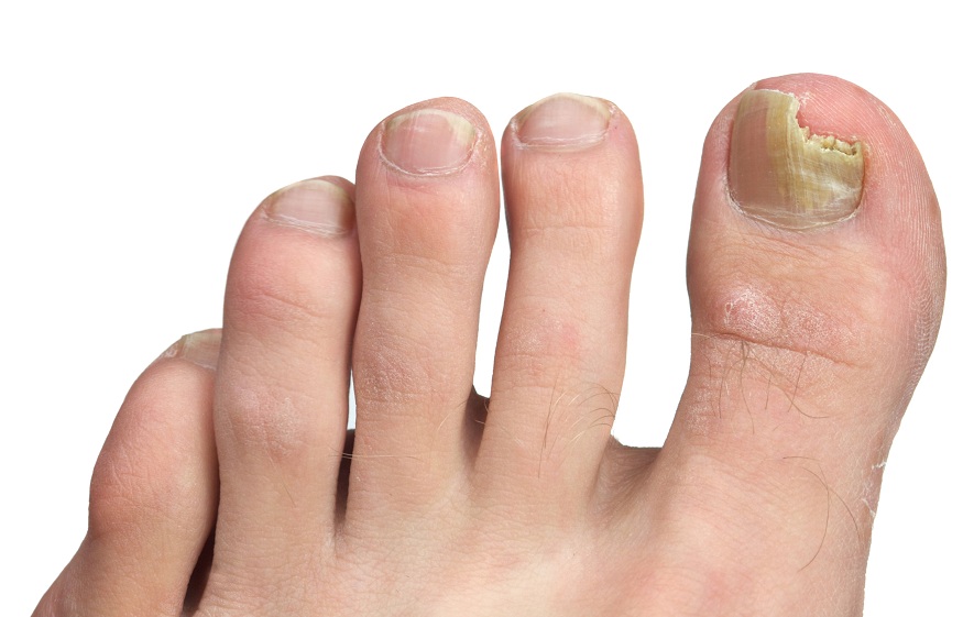 Mycosis of the nail (foot, hand): recognizing and treating onychomycosis