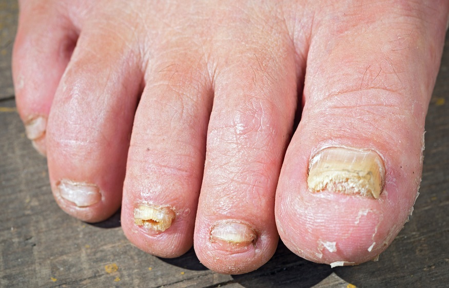 Nail fungus: an accurate diagnosis is necessary to guarantee recovery